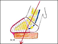 Bild 4: Lastachse bei korrektem Sitz des Klotzes (Schema)