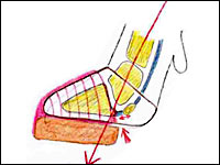 Bild 6: Lastachse und Druckstellen bei zu weit vorn sitzendem Klotz (Schema)